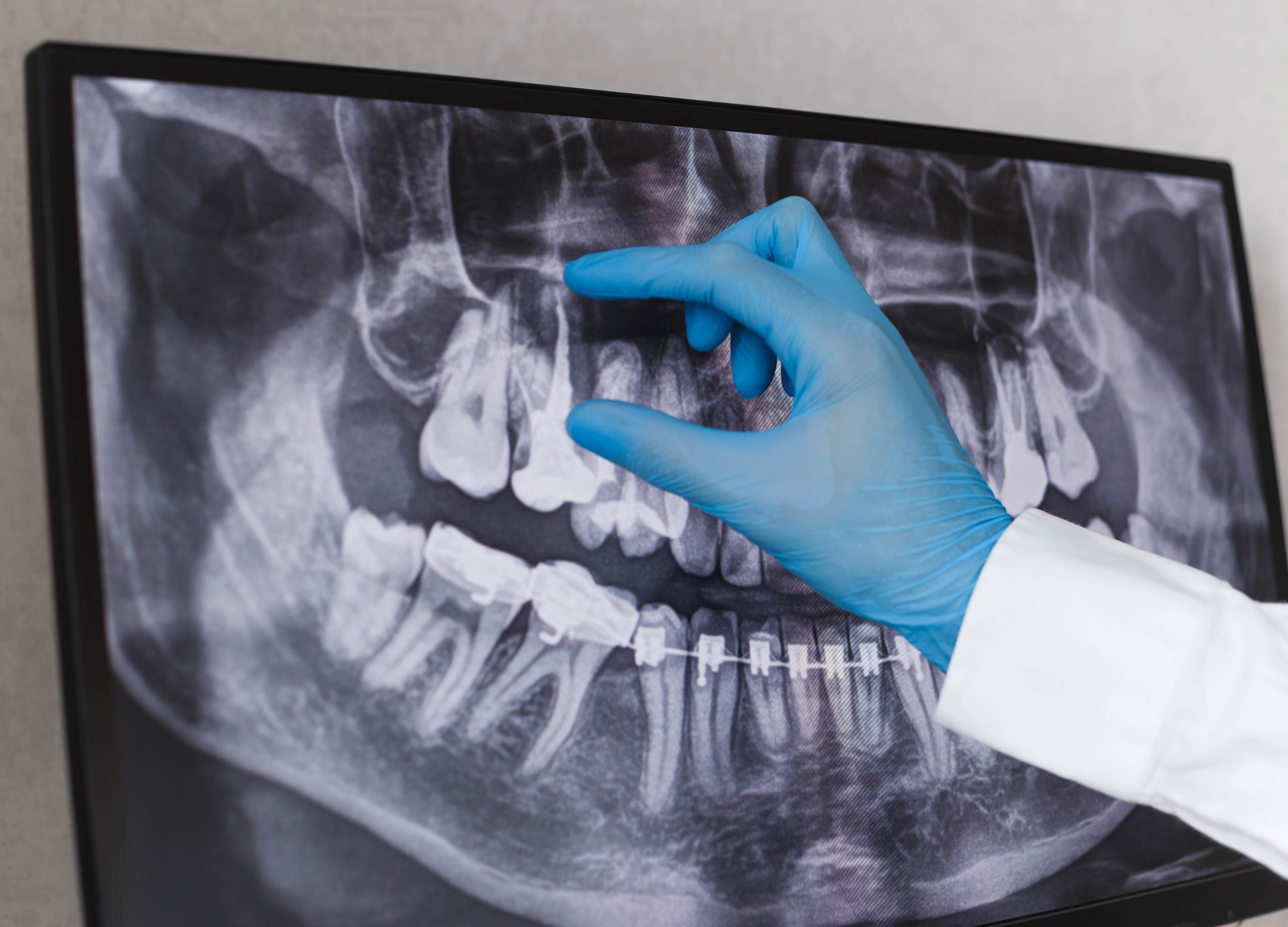 Dentist’s gloved hand pointing to a problem area on a dental X-ray during root canal diagnosis