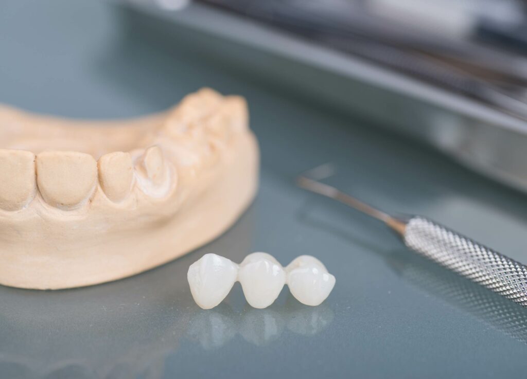 What Is a Dental Bridge?