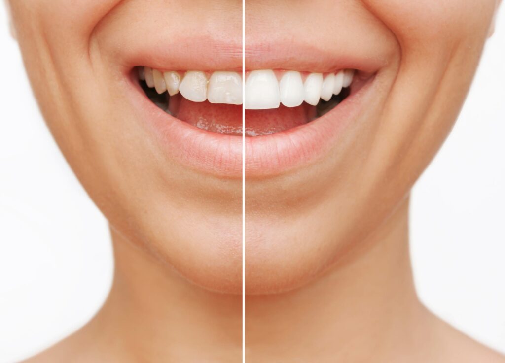 What Are the Benefits of Dental Veneers?