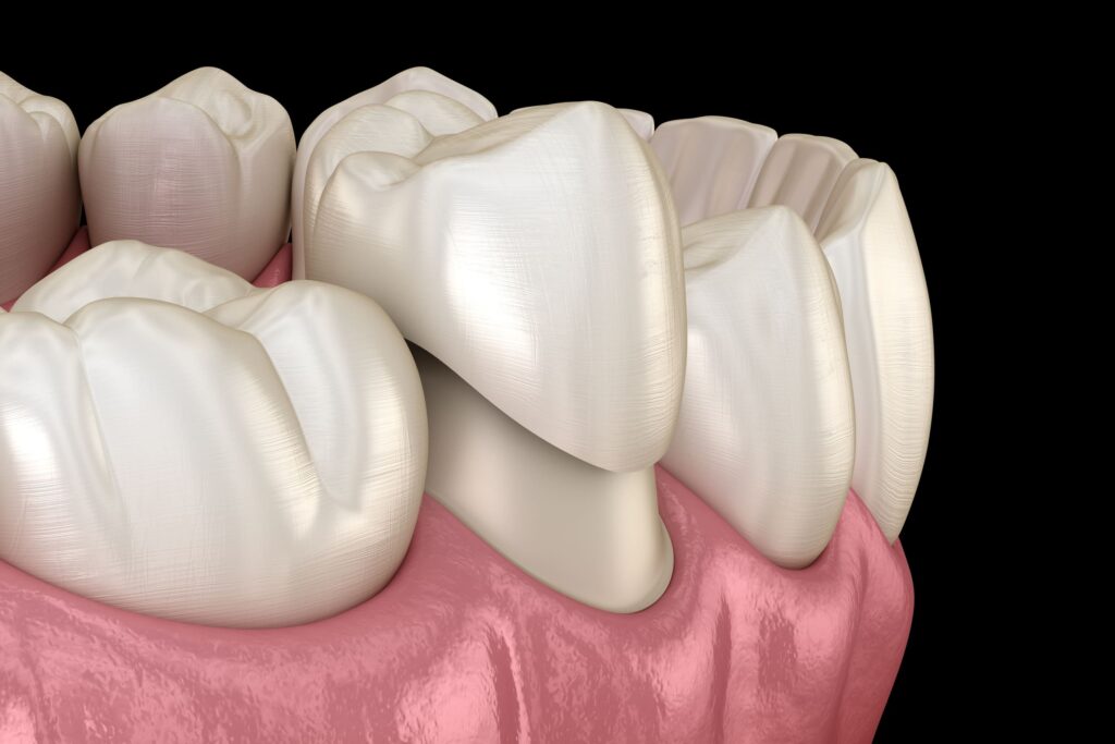 Recognizing the Signs: When to Consider a Crown Replacement